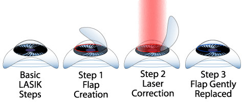 lasik_eye_surgery_procedure